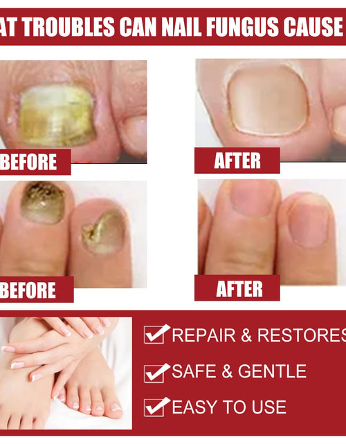 Load image into Gallery viewer, EELHOE Nail Repair Solution, Hands And Feet Nail Repair Moisturizing Clean And Remove Gray Nail Repair Solution

