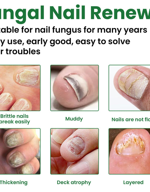 Load image into Gallery viewer, EELHOE Gray Nail Repair Remove Gray Nail Nourishing Lotion, Brightening Soft Nails Moisturizing Nail Care Solution For Hands, Feet And Nails
