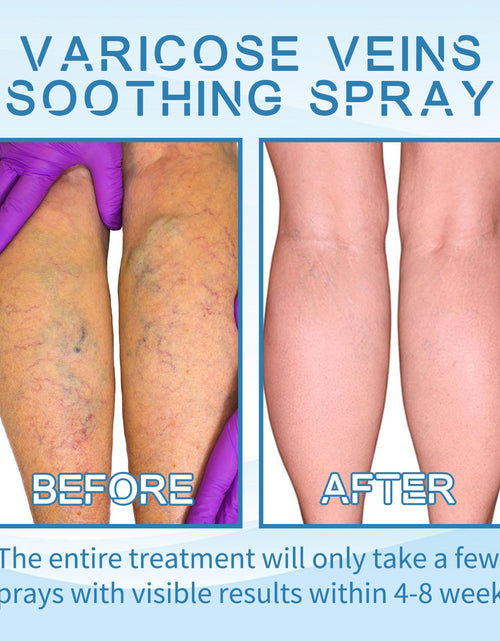 Load image into Gallery viewer, Vein Treatment Spray, Relieve Leg Soreness And Swelling Repair Earthworm Leg Vein Treatment Spray
