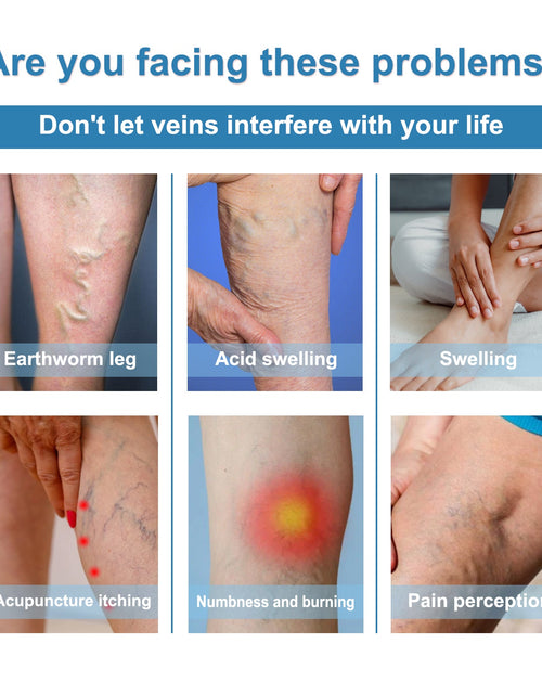 Load image into Gallery viewer, Vein Treatment Spray, Relieve Leg Soreness And Swelling Repair Earthworm Leg Vein Treatment Spray
