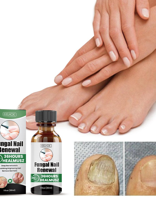 Load image into Gallery viewer, EELHOE Gray Nail Repair Remove Gray Nail Nourishing Lotion, Brightening Soft Nails Moisturizing Nail Care Solution For Hands, Feet And Nails
