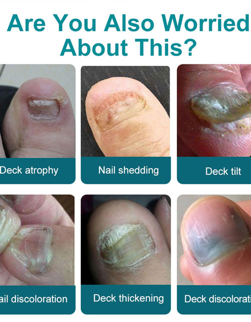 Load image into Gallery viewer, Gonnjunm Multi-Purpose Nail Solution Strengthener Growth Repair Care
