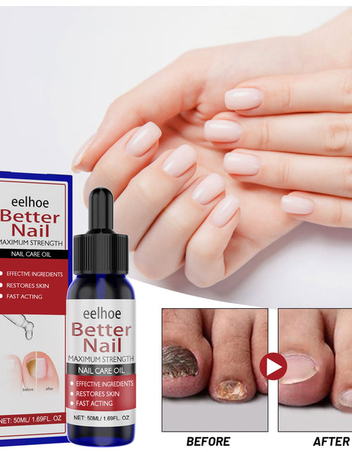 Load image into Gallery viewer, EELHOE Nail Repair Solution, Hands And Feet Nail Repair Moisturizing Clean And Remove Gray Nail Repair Solution
