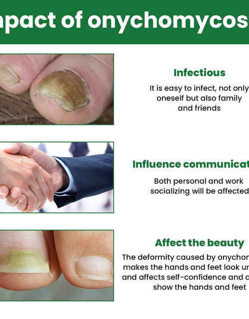 Load image into Gallery viewer, EELHOE Gray Nail Repair Remove Gray Nail Nourishing Lotion, Brightening Soft Nails Moisturizing Nail Care Solution For Hands, Feet And Nails
