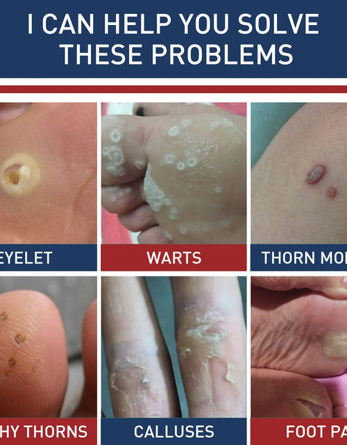 Load image into Gallery viewer, South Moon Gram Warty Corns Patch, Foot Soles Chicken Especially Clean Flesh Piercing Wart Wart Repair Patch Plain Sweat Tube Repair Patch
