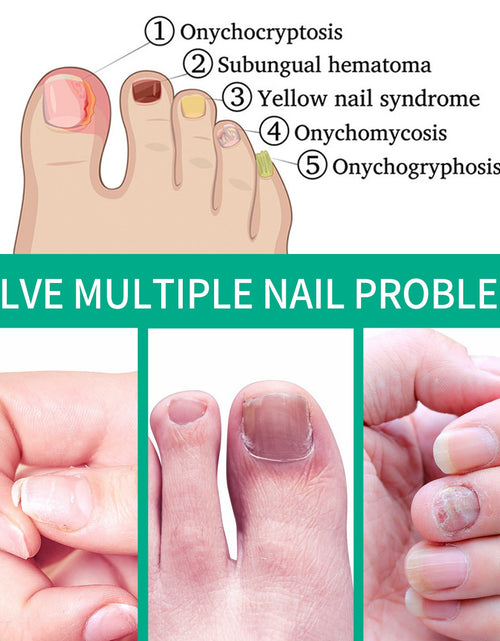 Load image into Gallery viewer, South Moon Nail Care Essence Moisturizes And Cleanses Hands, Feet And Nails And Brightening Nails Daily Care Essence
