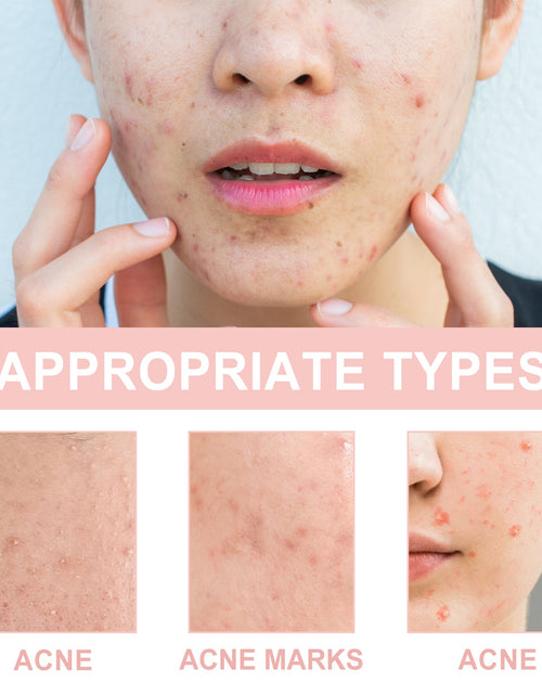 Load image into Gallery viewer, Acne Patch, Repair Acne Pimple Facial Redness Clean Pores Moisturize Skin Patch
