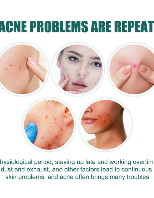 Load image into Gallery viewer, EELHOE Star Acne Patch Gentle Cleansing Lighten Acne Soothing Skin Acne Patch Facial Cleansing Treatment
