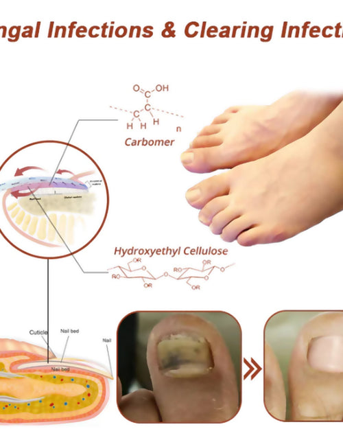 Load image into Gallery viewer, South Moon Nail Care Phototherapy Device, Repair Hands And Feet Gray Nails Yellow Ingrown Nail Soft Nail Care
