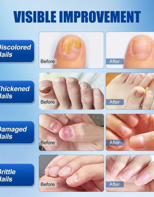 Load image into Gallery viewer, Wunila Toenail Fungus Treatment Extra Strength 30ml Multi-Purpose Nail Repair

