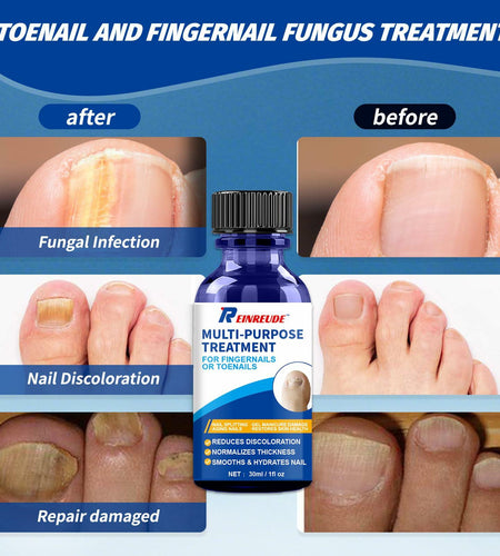 BestBy01/27 Toenail Fungus Treatment Extra Strength with Tolnaftate MultiPurpose