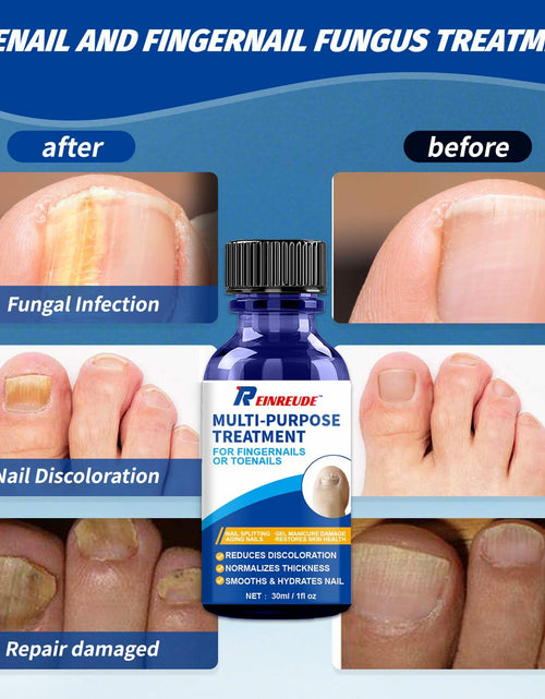 Load image into Gallery viewer, BestBy01/27 Toenail Fungus Treatment Extra Strength with Tolnaftate MultiPurpose
