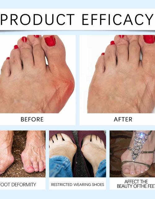 Load image into Gallery viewer, Befada Bunion Cushions Patch Waterproof Adhesive Pads for Men &amp; Women 10 Tablets
