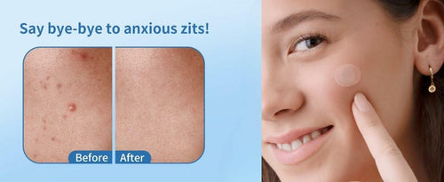 Load image into Gallery viewer, Chic Glamour Emporium Pimple Patch Hydrocolloid Acne Spot Stickers 72 Count
