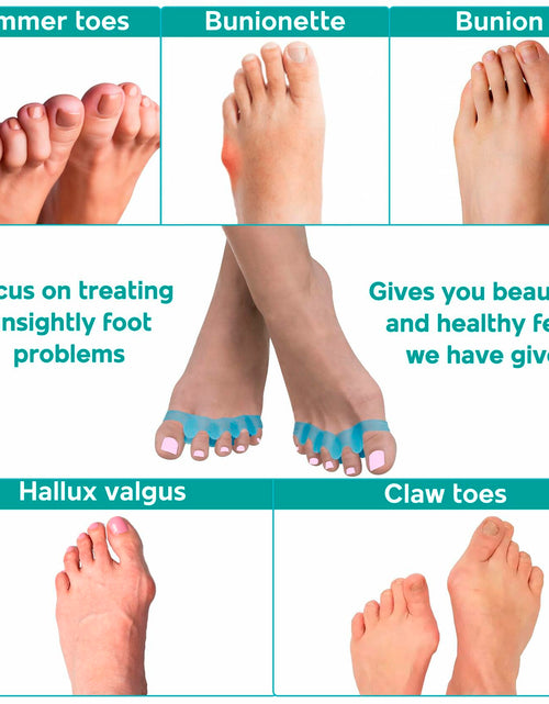 Load image into Gallery viewer, NAMELESS NICHE Toe Separators Bunion Corrector Toe Spacers White 1 Pair
