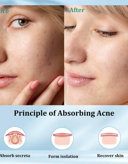 Load image into Gallery viewer, SHIVRISE Pimple Patch Hydrocolloid Acne Spot Cover Tea Tree Oil 36 Count
