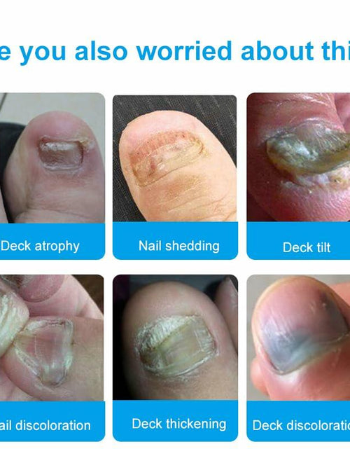 Load image into Gallery viewer, Toenail Fungus Treatment Extra Strength Nail Repair Foot Care
